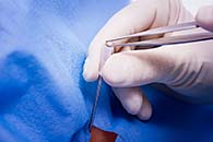 Goldimplantation für Menschen - Alternative Behandlungsmethode für Gelenkerkrankungen - Arthritis - Arthrose